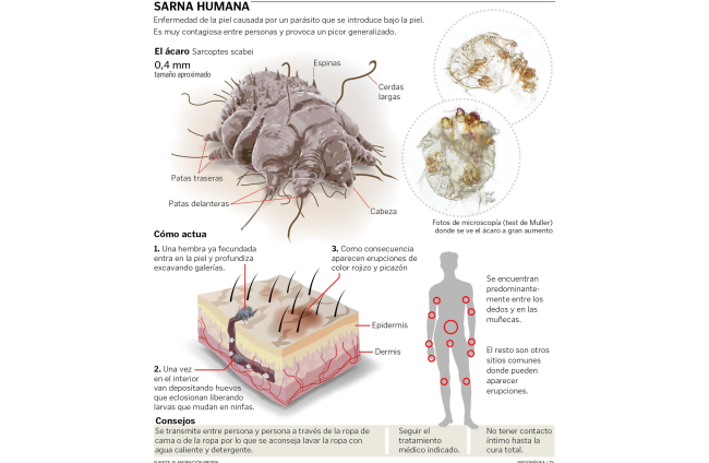 Los casos de sarna aumentan en España: cómo se contagia y cuál es su  tratamiento