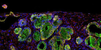 Un equipo internacional de investigadores ha señalado a una proteína antibacteriana como posible diana terapéutuca para actuar contra la raíz del cáncer de páncreas y en un futuro poder obtener mejoras en su tratamiento. En la imagen, inmunofluorescencia de un tumor de páncreas, con esa proteína en verde. Imagen: Bruno Sainz/CSIC