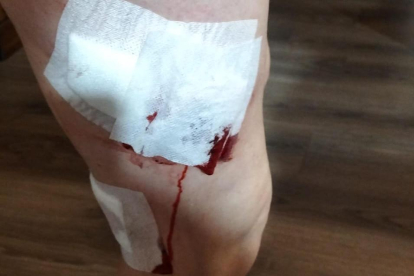Herida por moderdura en la pierna, en la que tuvo que recibir puntos.