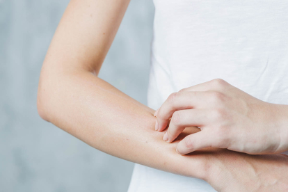 ¿Dermatitis atópica en verano?: Cómo puedes tratarla en casa