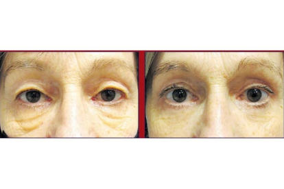 Los resultados son visibles en estas fotografías del antes y el después de una paciente intervenida por el doctor Toribio de blefaroplastia láser de párpados superiores e inferiores. DL