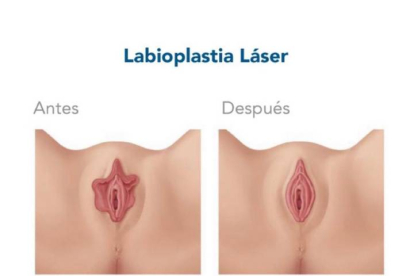 Imágenes que ilustran el antes y el después de una labioplastia y el uso del láser para intervenir en la zona genital. HM SAN FRANCISCO