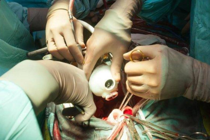 Operación para colocar un corazón artificial en un hospital de Navarra.