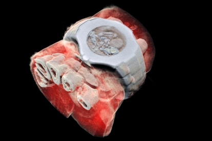 Imagen de la radiografía en 3D de una muñeca.