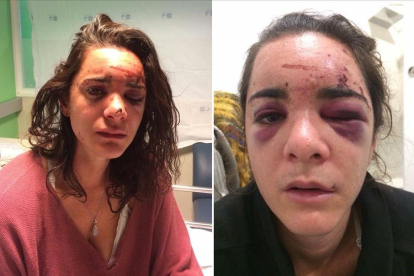 Andrea Sicignano  en dos fotografías publicadas por ella misma en su cuenta de Facebook tras la violación y agresión que sufrio en Aluche (Madrid).