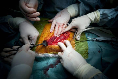Varios cirujanos trabajan en una operación de transplante de riñón de un donante vivo
