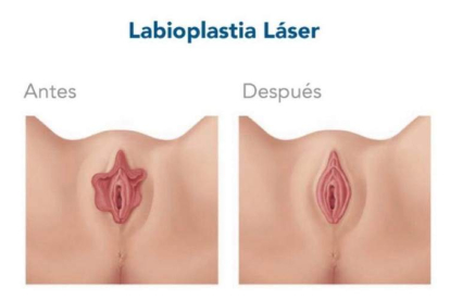 Imágenes que ilustran el antes y el después de una labioplastia y el uso del láser para intervenir en la zona genital. CENTRO GINECOLÓGICO HM SAN FRANCISCO