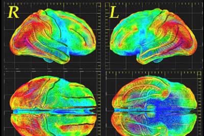 En el mapa de la fotografía se puede observar un cerebro completo de una persona que sufre esquizofrenia.