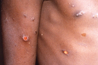 Entre los síntomas de la viruela del mono están las afecciones en la piel. DL