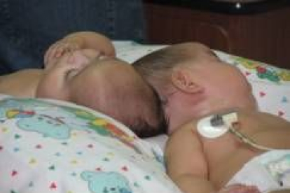 Sofía y Mariana nacieron el 19 de septiembre unidas por el cráneo