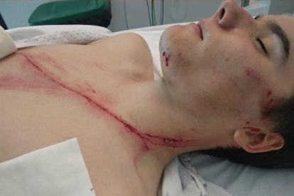 Andoni Azkarate con la herida que se produjo tras impactar con un guardarraíl en el Campeonato de Euskadi de ciclismo amateur.