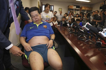 Howard Lam, con la camiseta del Barça, expone las heridas de sus piernas en una conferencia en Hong Kong el viernes 11 de agosto.