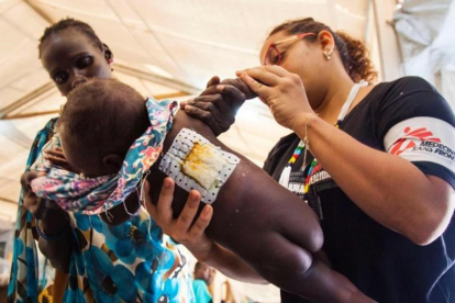 Una enfermera examina a una niña que sufre una infección en la piel, en el hospital de MSF de Malakal (Sudán del Sur), el 15 de junio.