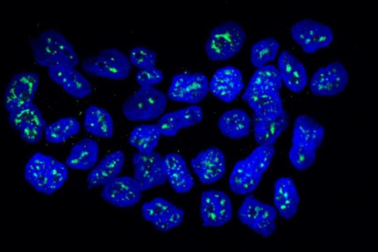 Núcleos de células metastáticas de cáncer de mama con la proteína MSK1 en verde.