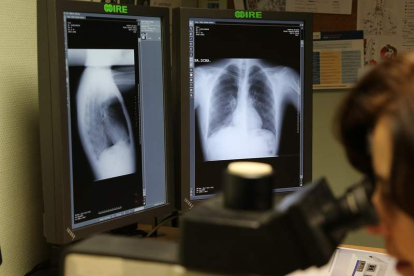El 70% de los cánceres de pulmón se diagnostican en fases avanzadas. SECUNDINO PÉREZ