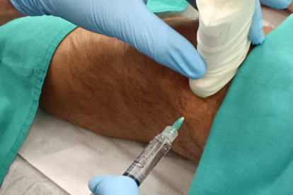 Inyección de ácido hialurónico en la rodilla de un paciente.