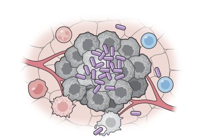 Células bacterianas artificiales (púrpura) activan varias partes del sistema inmunitario para atacar a las células tumorales (gris). Crédito: Universidad de Columbia