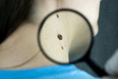 La valoración visual directa y el uso de herramientas dermatológicas permiten examinar un lunar con más precisión que una fotografía enviada a una inteligencia artificial.