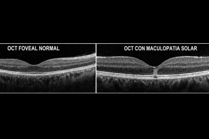 Prueba diagnóstica en la que se ve el daño en la mácula.