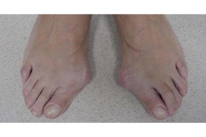 Juanete en los pies. DL