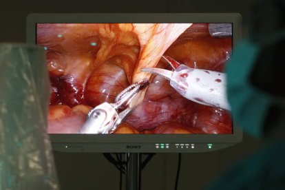 Una de las primeras operaciones de extirpación de la glándula prostática en un paciente con cáncer en el centro médico quirúrgico del Hospital San Juan de Dios, con los especialistas Miguel Ángel Alonso Prieto y Miguel García Sanz al frente. RAMIRO