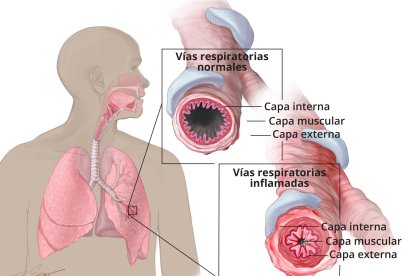 Recreación de las vías respiratorias normales y las inflamadas por el asma.