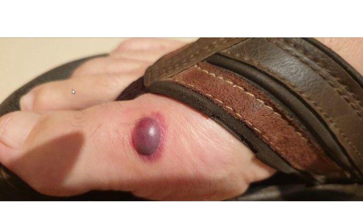 Una de las funcionarias afectadas por picaduras de chinches en la prisión de Valdemoro muestra esta ampolla en uno de sus pies.