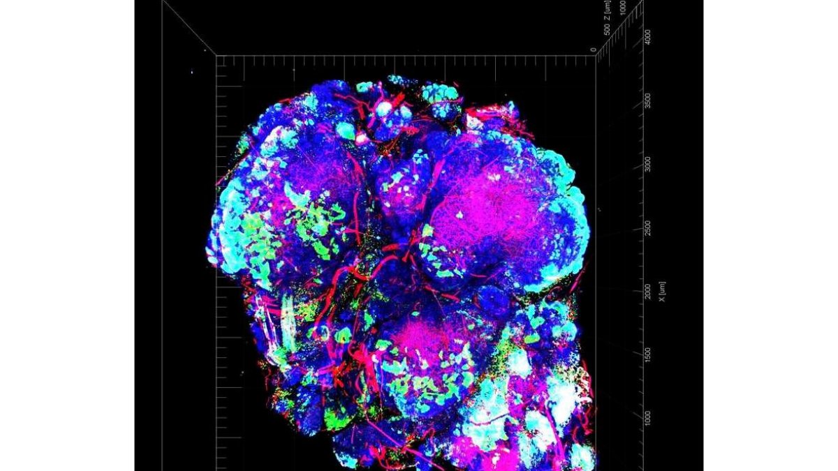 Tumor con zonas de hipoxia en color verde. National Cancer Institute / University of Chicago