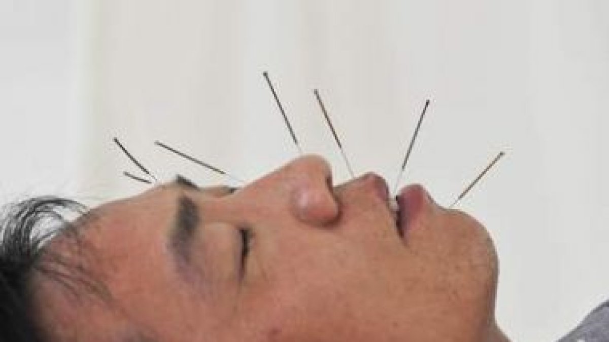 Un hombre recibe acupuntura para tratar una parálisis facial en un hospital de Shenyang.