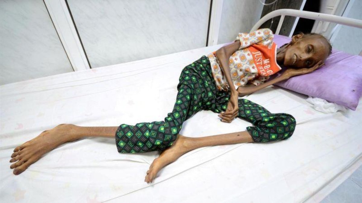 La joven Saida Ahmed Baghili, de 18 años, es atendida en el hospital de Al-Thawra, de la ciudad yemení de Hodeidah, de su severa malnutrición.
