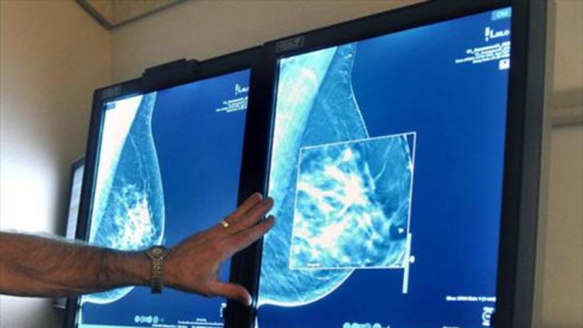 Un radiólogo compara dos mamografías para detectar tumores.