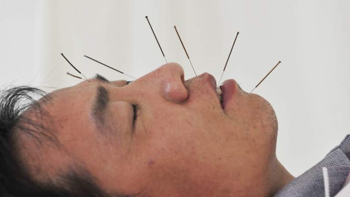 Un hombre se somete a una sesión de acupuntura. MARK