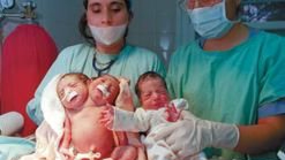 Las dos siamesas argentinas poco después de nacer junto con su hermana trilliza