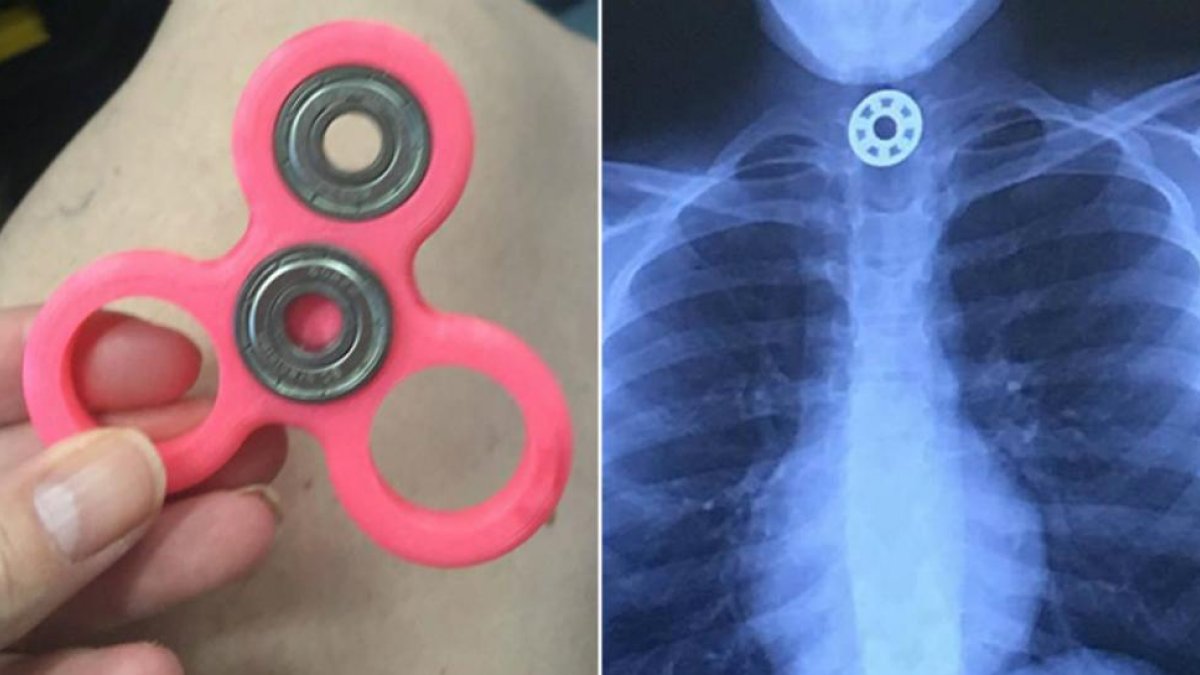 El Fidget Spinner y la radiografía en la que se aprecia la pieza del juguete en el esófago de la niña.