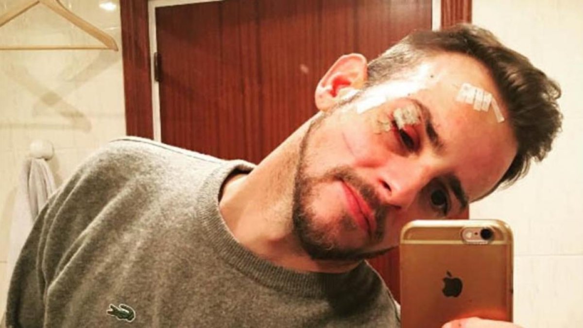 Àlex Casademunt muestra su rostro con múltiples heridas, tras sufrir una agresión el pasado 15 de enero en una discoteca de Vigo