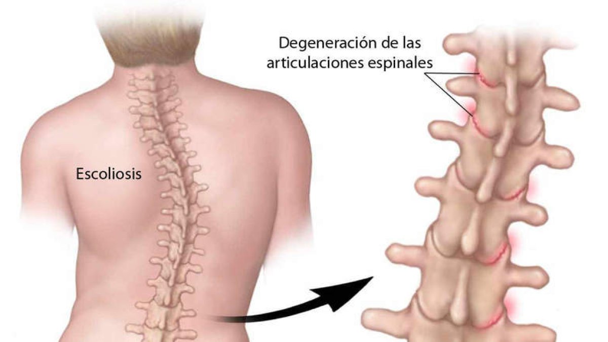 La escoliosis una deformación de la columna vertebral que en los casos leves suele estar infradiagnosticada. MAYO CLINIC NEWS NETWORK