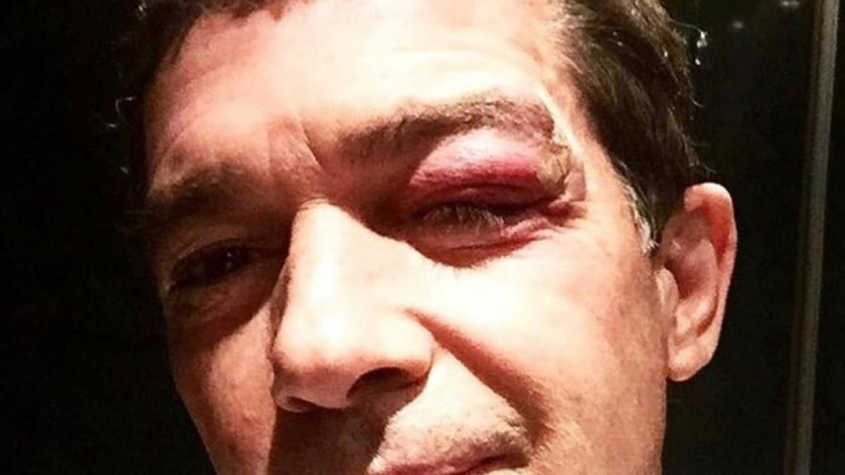 El actor Antonio Banderas, con el ojo morado.