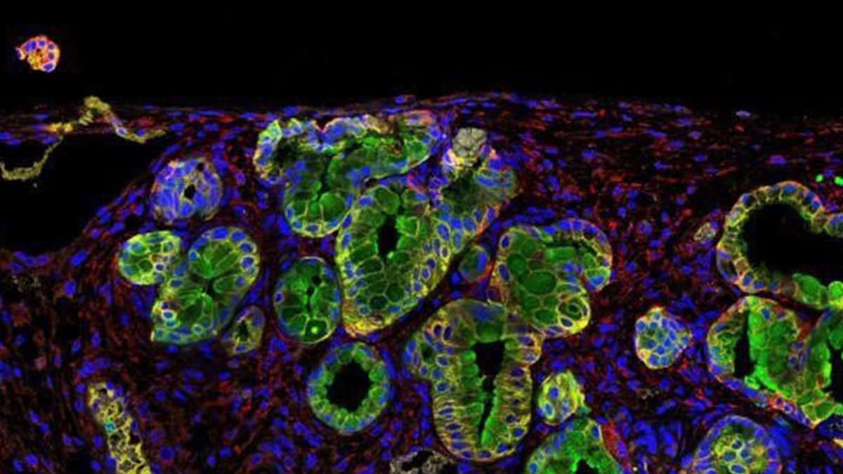 Un equipo internacional de investigadores ha señalado a una proteína antibacteriana como posible diana terapéutuca para actuar contra la raíz del cáncer de páncreas y en un futuro poder obtener mejoras en su tratamiento. En la imagen, inmunofluorescencia de un tumor de páncreas, con esa proteína en verde. Imagen: Bruno Sainz/CSIC