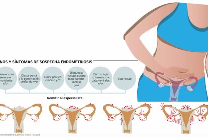 Endometriosis