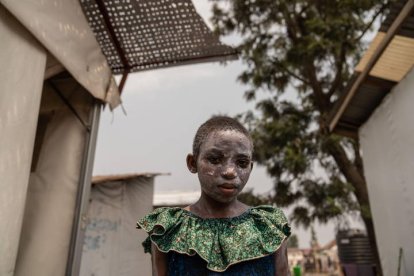 Lucie Habimana, de 13 años, tiene la cara cubierta con ungüento después de recibir tratamiento para el mpox en el Centro de Salud Munigi en Munigi, República Democrática del Congo, el 16 de agosto de 2024. El Centro Europeo para la Prevención y el Control de Enfermedades (ECDC) advirtió que es probable que Europa registre más casos importados debido a la propagación del virus en varias naciones africanas después de que la Organización Mundial de la Salud declarara la propagación del mpox en África como una emergencia sanitaria mundial. El mpox pertenece a la misma familia de virus que la viruela, pero causa síntomas más leves como fiebre, escalofríos y dolores corporales. EFE/EPA/MOISE KASEREKA