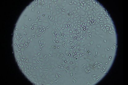 Una imagen al microscopio de las células tumorales de cáncer de páncreas. EFE/Crédito: Imagen cedida por el Hospital 12 de Octubre.