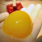 Imagen del gel de plaquetas que sirve para restituir el volumen de una mama.