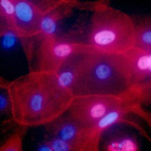 Células de cáncer de mama.