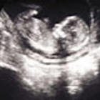 Ecografía de un feto de 14 semanas de gestación.