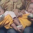 Las pequeñas surcoreanas de cuatro meses de edad son sostenidas en brazos antes de la intervención