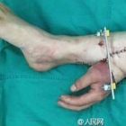 Los cirujanos injertaron la mano en su pierna para mantener el flujo sanguineo.