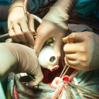 Operación para colocar un corazón artificial en un hospital de Navarra.