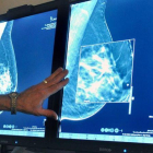 Examen radiológico de un cáncer de mama.