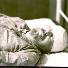 Trotsky, en el hospital, tras sufrir el ataque de Ramón Mercader