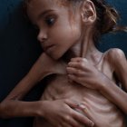 La niña Amal, fallecida por desnutrición